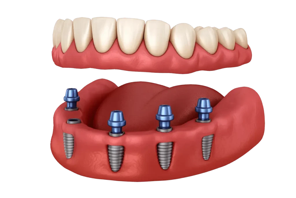 Overdenture