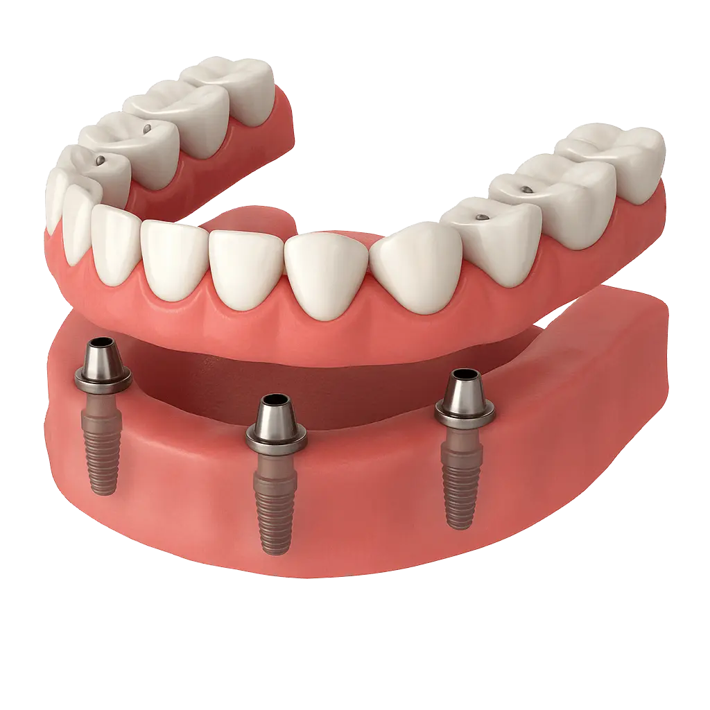 Overdenture su impianti
